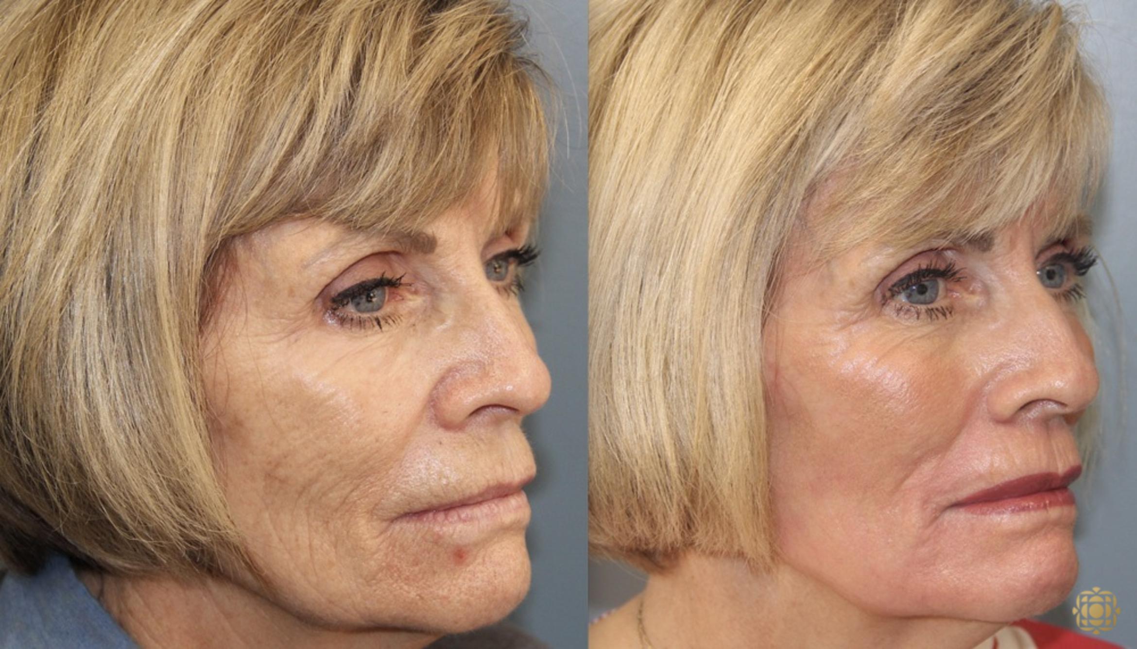 Before & After Fractional CO2 Laser Skin Resurfacing Case 350 Left Oblique View in Newport Beach, CA