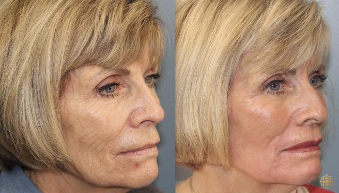 Before & After Fractional CO2 Laser Skin Resurfacing Case 350 Left Oblique View in Newport Beach, CA