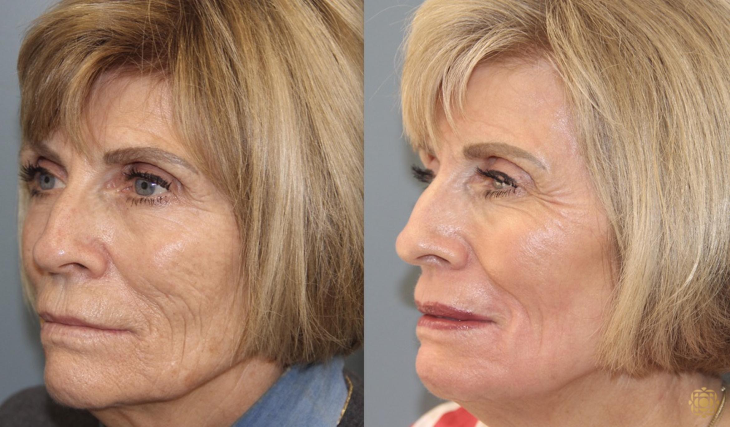 Before & After Fractional CO2 Laser Skin Resurfacing Case 350 Right Oblique View in Newport Beach, CA