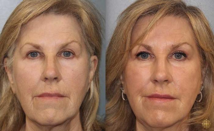 Before & After Fractional CO2 Laser Skin Resurfacing Case 353 Front View in Newport Beach, CA