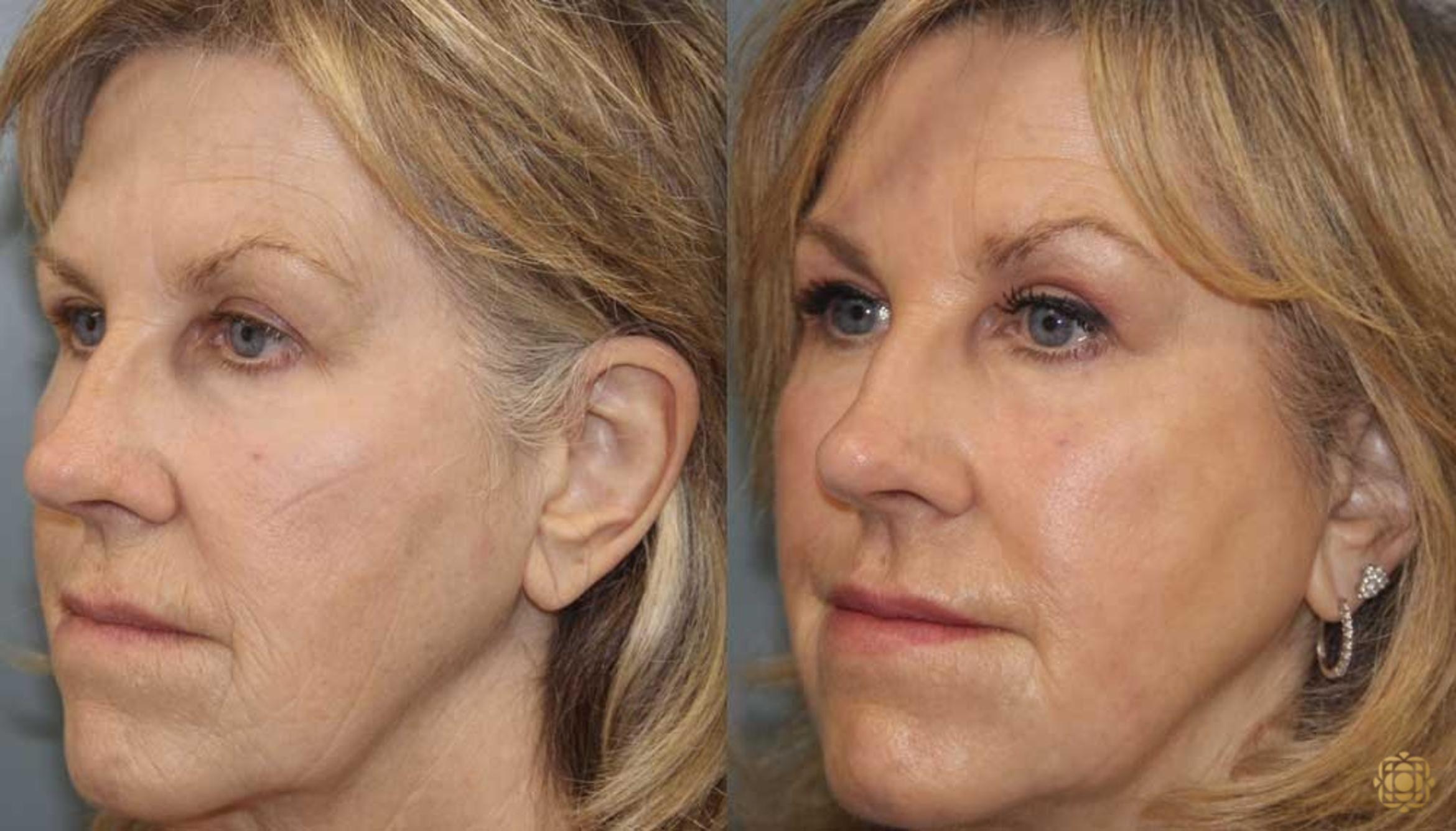 Before & After Fractional CO2 Laser Skin Resurfacing Case 353 Left Oblique View in Newport Beach, CA