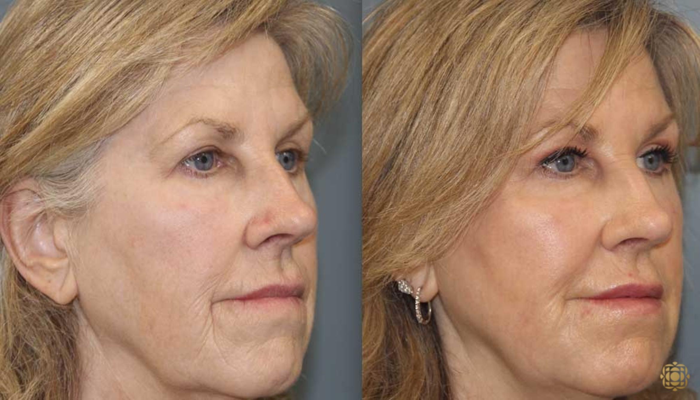 Before & After Fractional CO2 Laser Skin Resurfacing Case 353 Right Oblique View in Newport Beach, CA