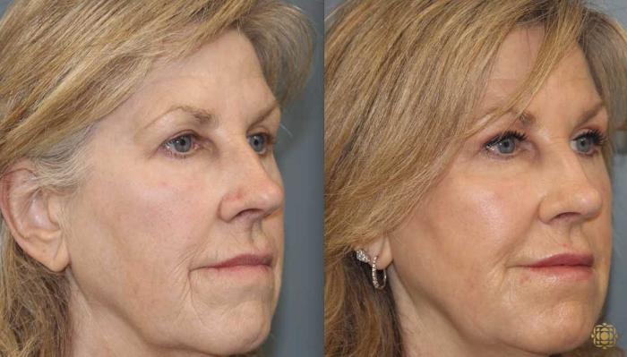 Before & After Fractional CO2 Laser Skin Resurfacing Case 353 Right Oblique View in Newport Beach, CA