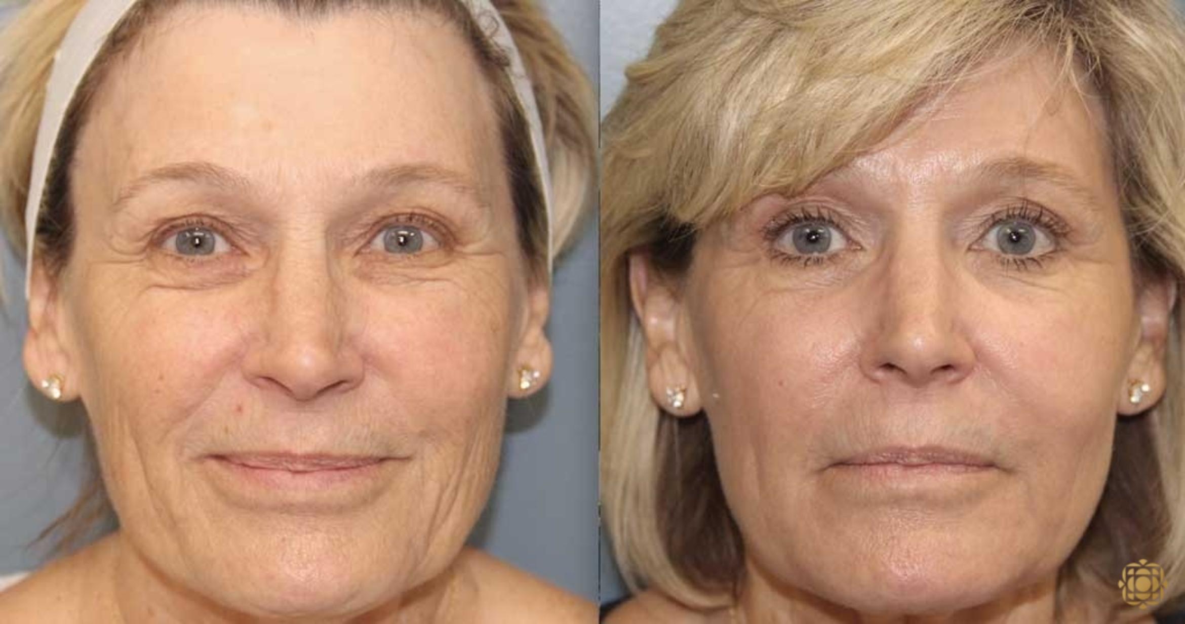 Before & After Fractional CO2 Laser Skin Resurfacing Case 362 Front View in Newport Beach, CA