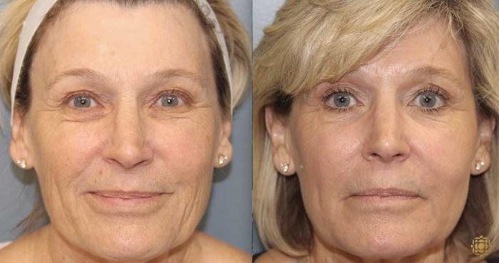 Before & After Fractional CO2 Laser Skin Resurfacing Case 362 Front View in Newport Beach, CA