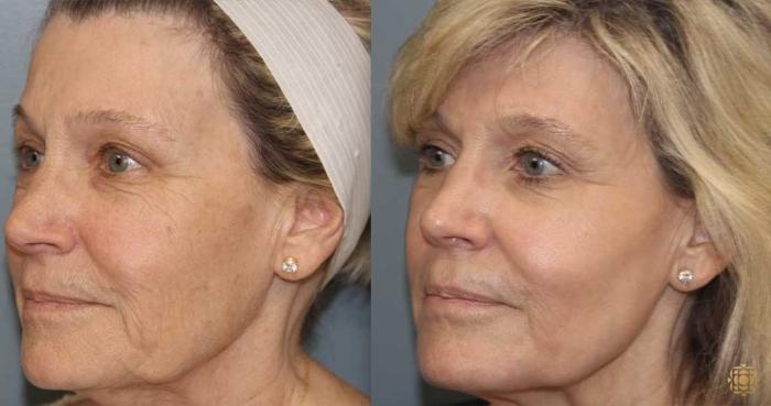 Before & After Fractional CO2 Laser Skin Resurfacing Case 362 Left Oblique View in Newport Beach, CA