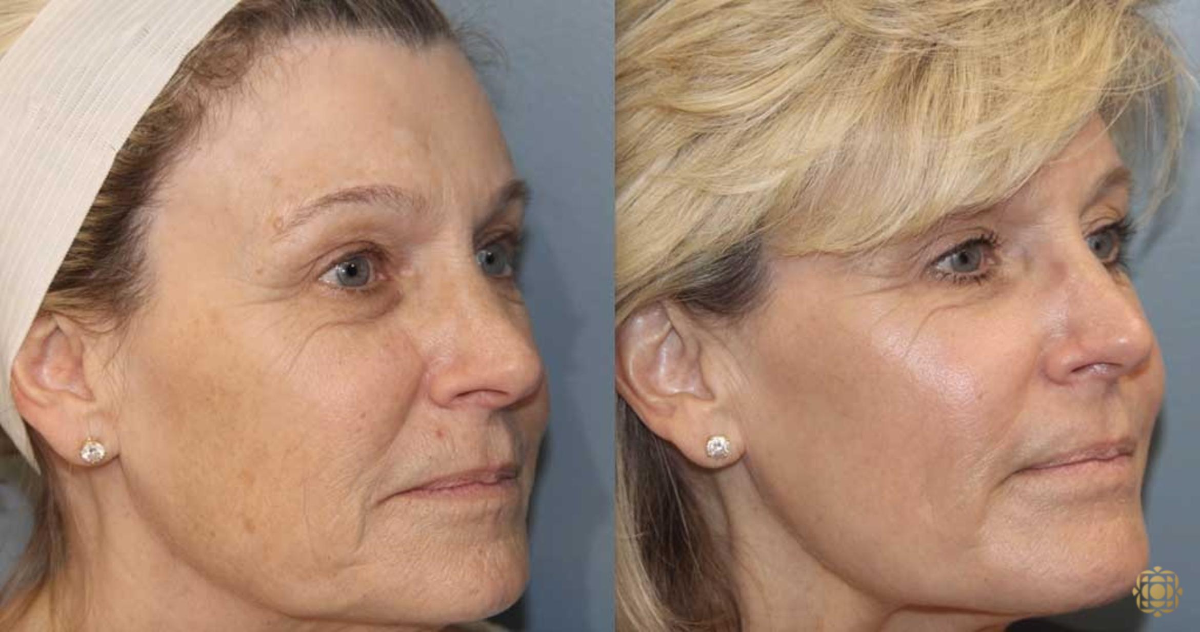 Before & After Fractional CO2 Laser Skin Resurfacing Case 362 Right Oblique View in Newport Beach, CA