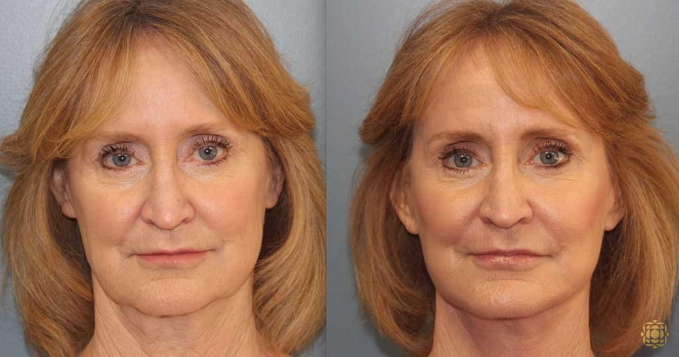 Before & After Fractional CO2 Laser Skin Resurfacing Case 368 Front View in Newport Beach, CA