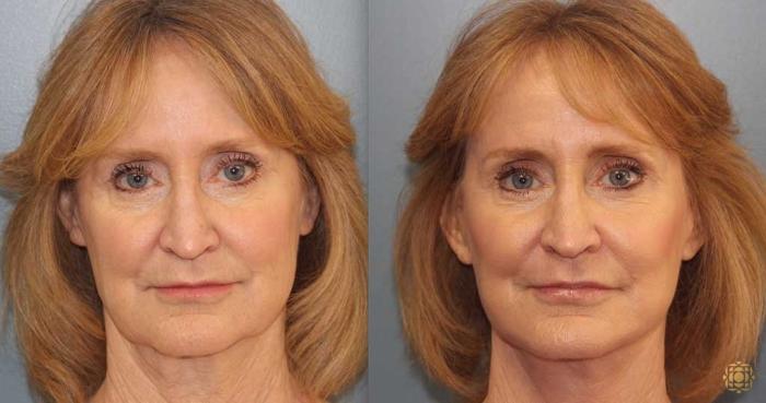 Before & After Fractional CO2 Laser Skin Resurfacing Case 368 Front View in Newport Beach, CA