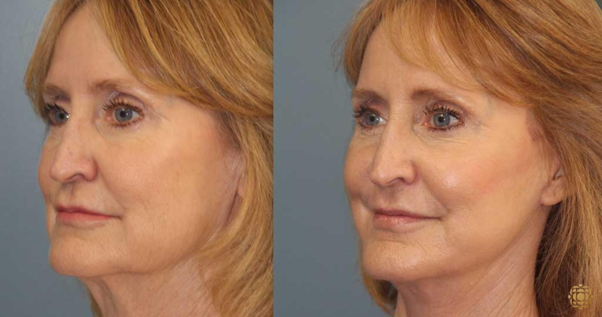 Before & After Fractional CO2 Laser Skin Resurfacing Case 368 Left Oblique View in Newport Beach, CA