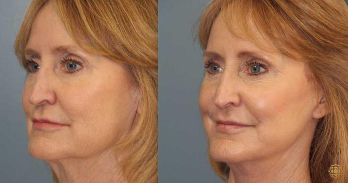 Before & After Fractional CO2 Laser Skin Resurfacing Case 368 Left Oblique View in Newport Beach, CA