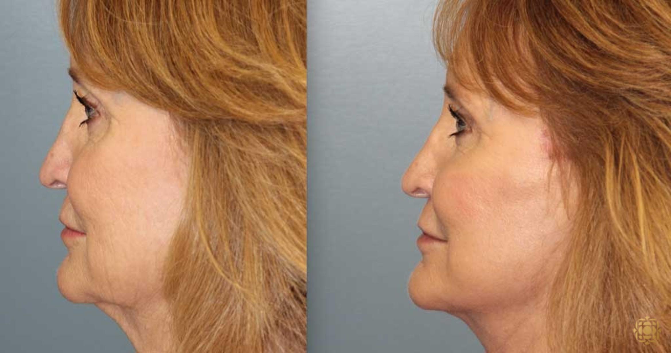 Before & After Fractional CO2 Laser Skin Resurfacing Case 368 Left Side View in Newport Beach, CA