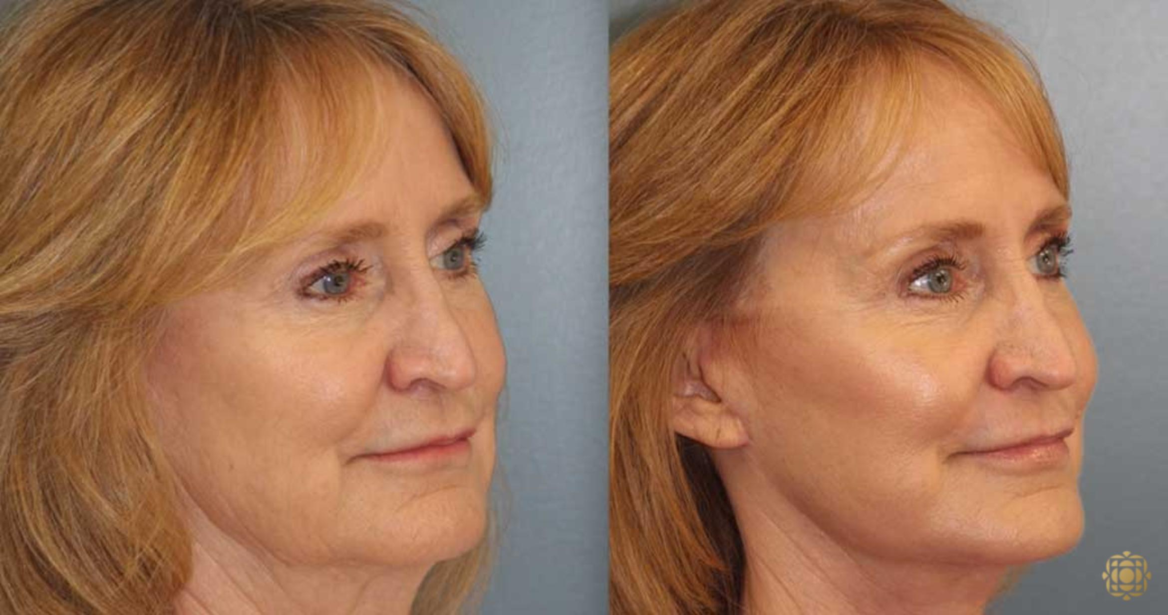 Before & After Fractional CO2 Laser Skin Resurfacing Case 368 Right Oblique View in Newport Beach, CA