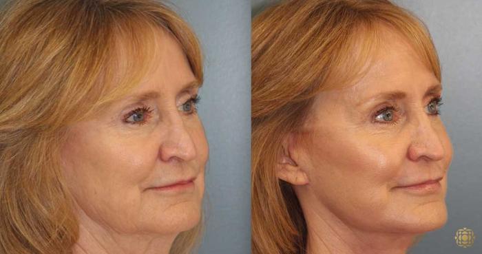 Before & After Fractional CO2 Laser Skin Resurfacing Case 368 Right Oblique View in Newport Beach, CA