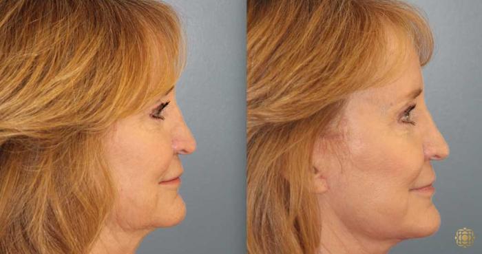 Before & After Fractional CO2 Laser Skin Resurfacing Case 368 Right Side View in Newport Beach, CA