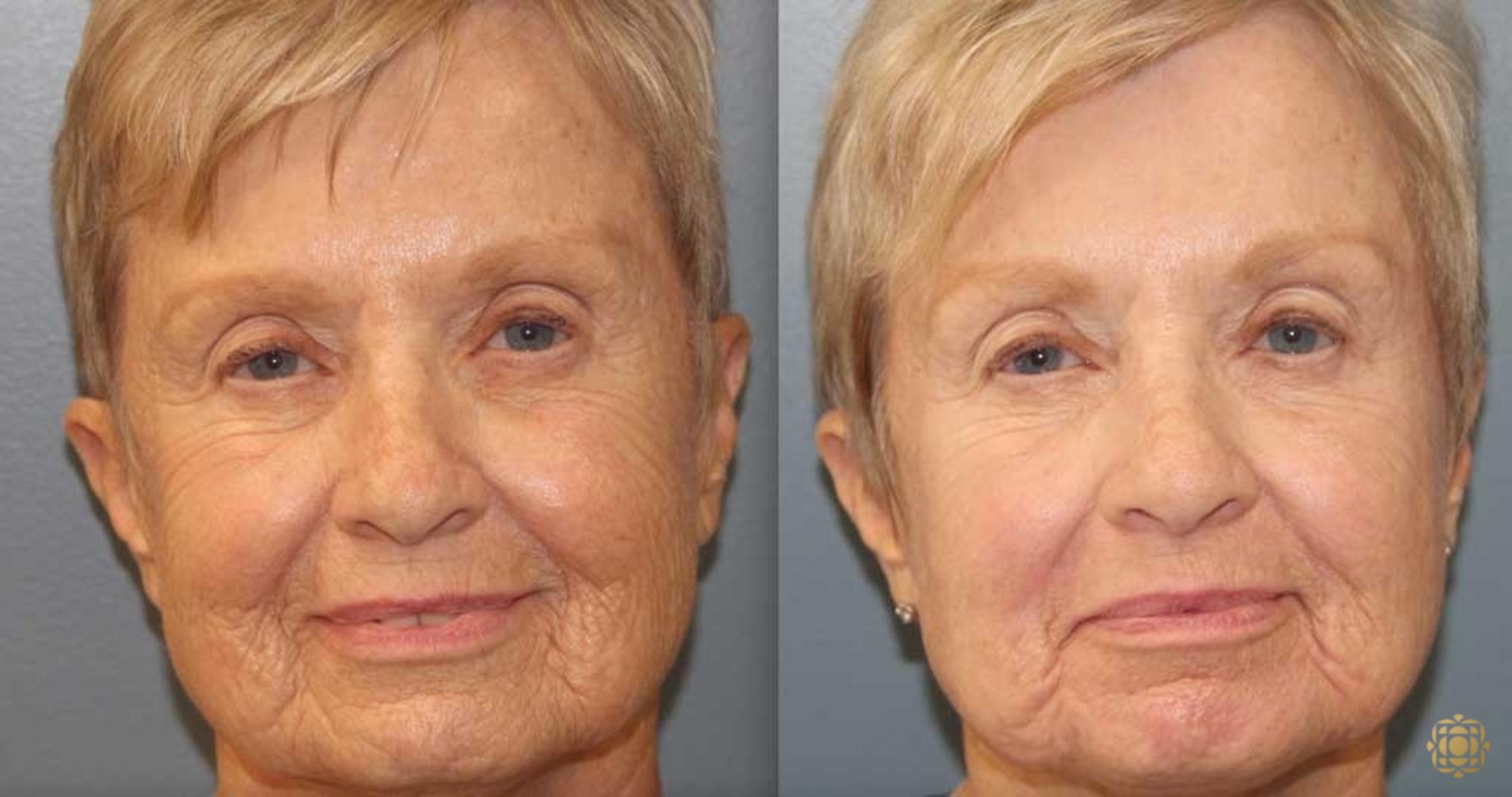 Before & After Fractional CO2 Laser Skin Resurfacing Case 369 Front View in Newport Beach, CA