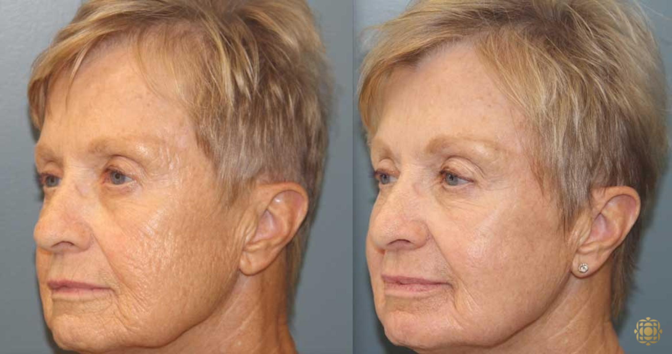 Before & After Fractional CO2 Laser Skin Resurfacing Case 369 Left Oblique View in Newport Beach, CA