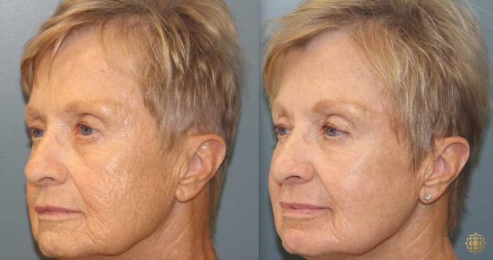 Before & After Fractional CO2 Laser Skin Resurfacing Case 369 Left Oblique View in Newport Beach, CA