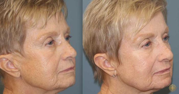Before & After Fractional CO2 Laser Skin Resurfacing Case 369 Right Oblique View in Newport Beach, CA
