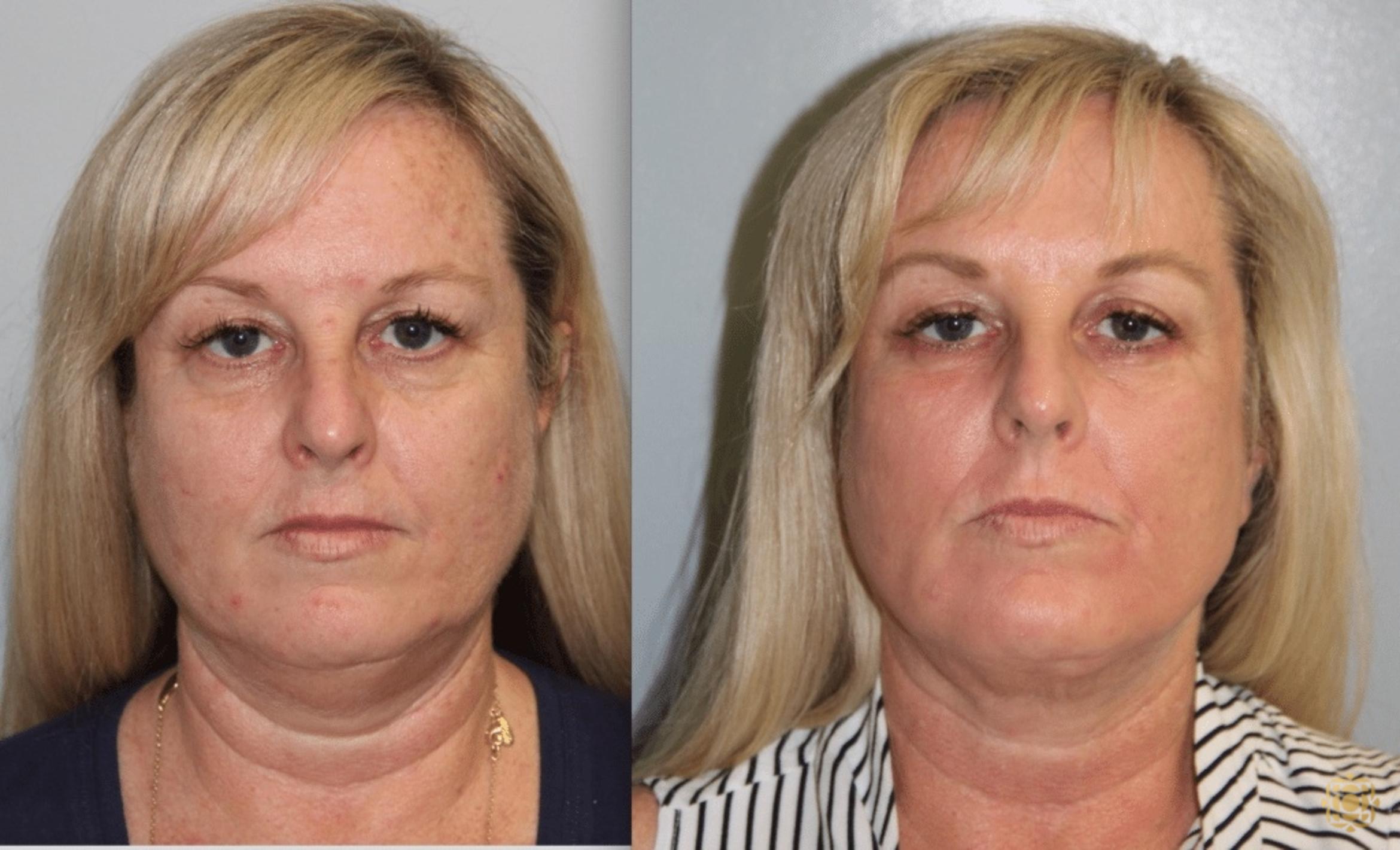 Before & After Fractional CO2 Laser Skin Resurfacing Case 397 Front View in Newport Beach, CA
