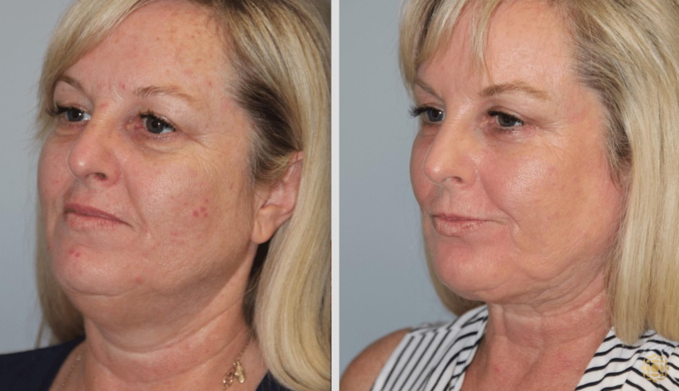 Before & After Fractional CO2 Laser Skin Resurfacing Case 397 Left Oblique View in Newport Beach, CA