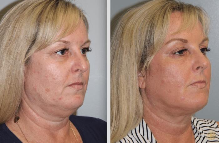 Before & After Fractional CO2 Laser Skin Resurfacing Case 397 Right Oblique View in Newport Beach, CA