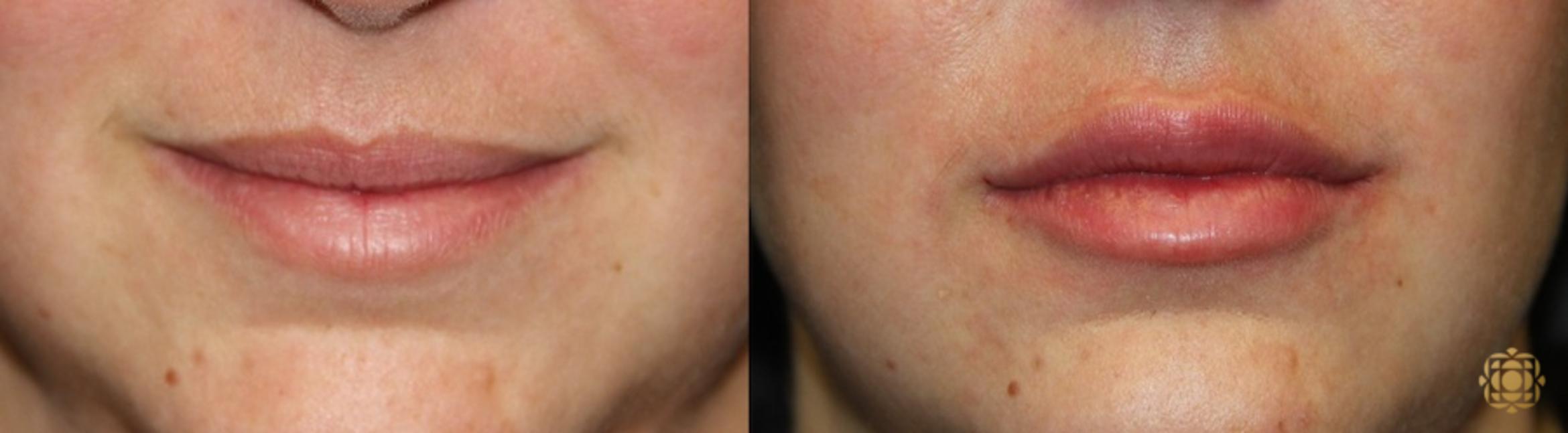 Before & After Injectables Case 374 View #1 View in Newport Beach, CA