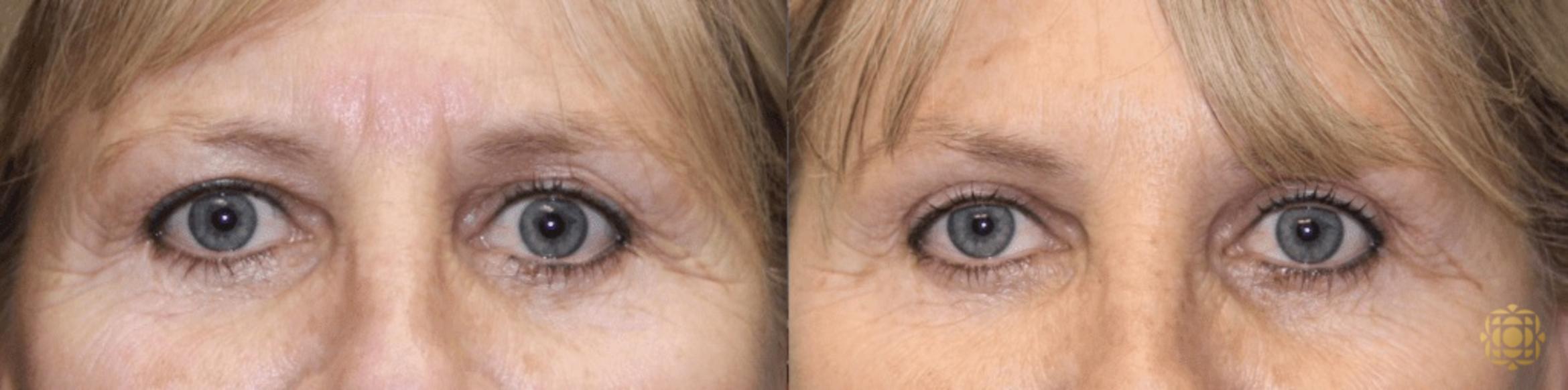 Before & After Injectables Case 375 View #1 View in Newport Beach, CA