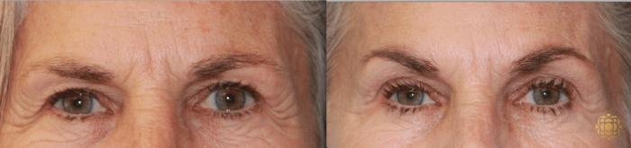 Before & After Injectables Case 376 View #1 View in Newport Beach, CA