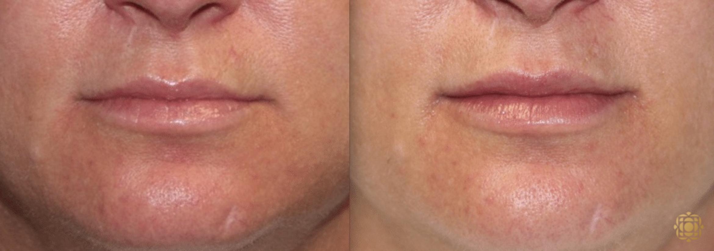 Before & After Injectables Case 377 View #1 View in Newport Beach, CA