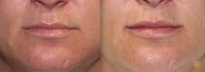 Before & After Injectables Case 377 View #1 View in Newport Beach, CA