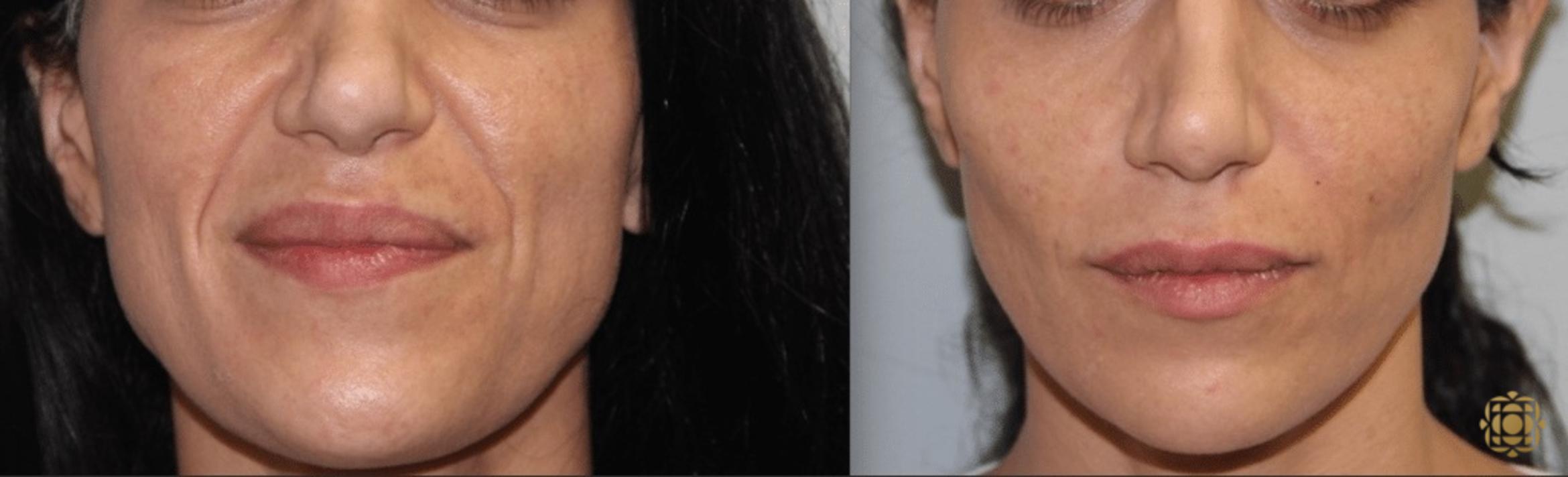 Before & After Injectables Case 378 View #1 View in Newport Beach, CA
