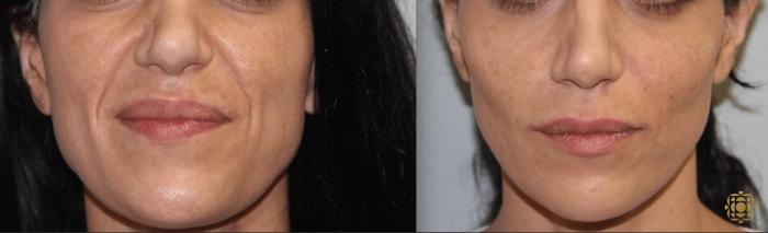 Before & After Injectables Case 378 View #1 View in Newport Beach, CA