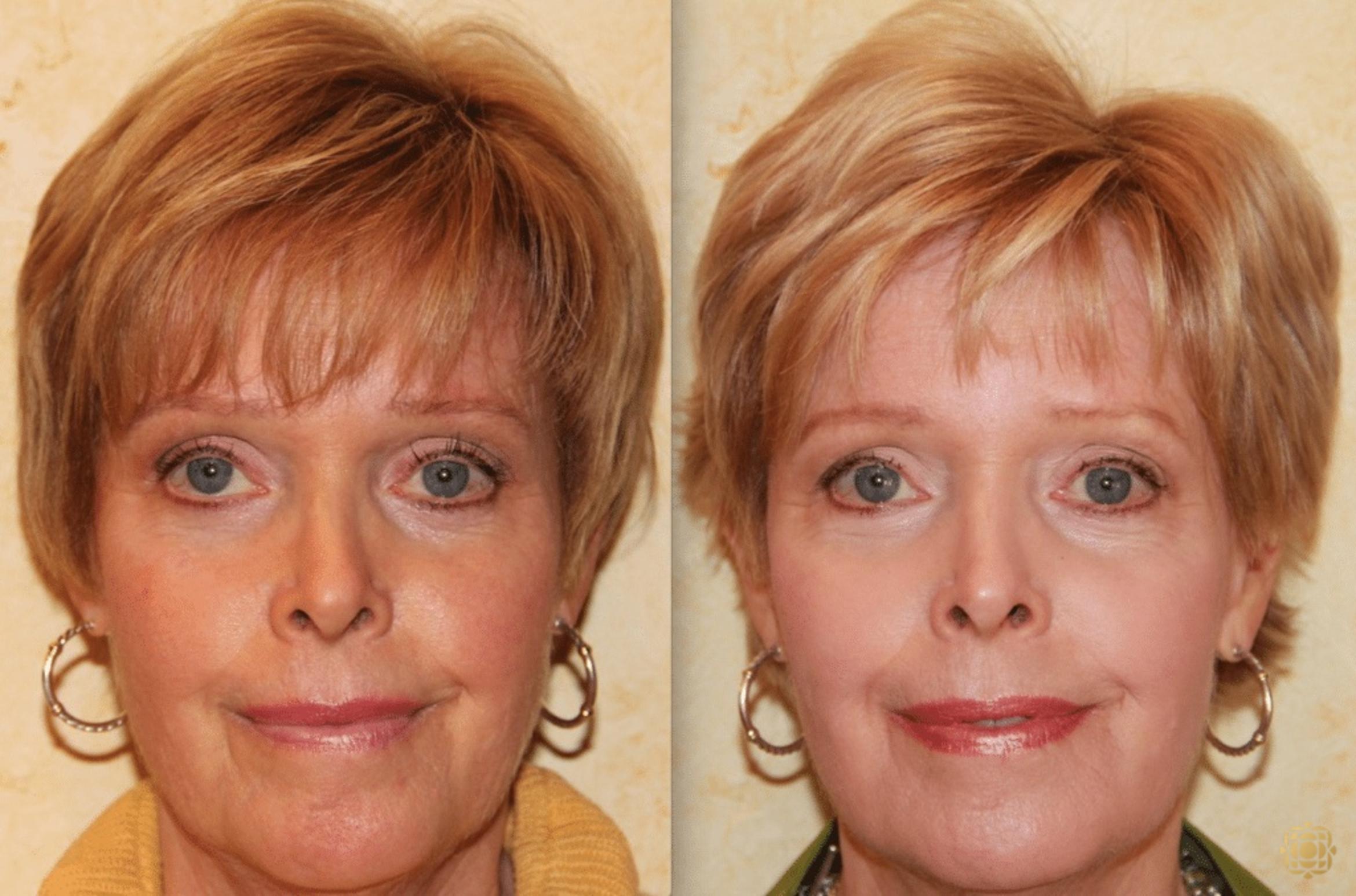 Before & After Injectables Case 380 View #1 View in Newport Beach, CA