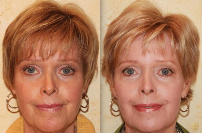 Before & After Injectables Case 380 View #1 View in Newport Beach, CA