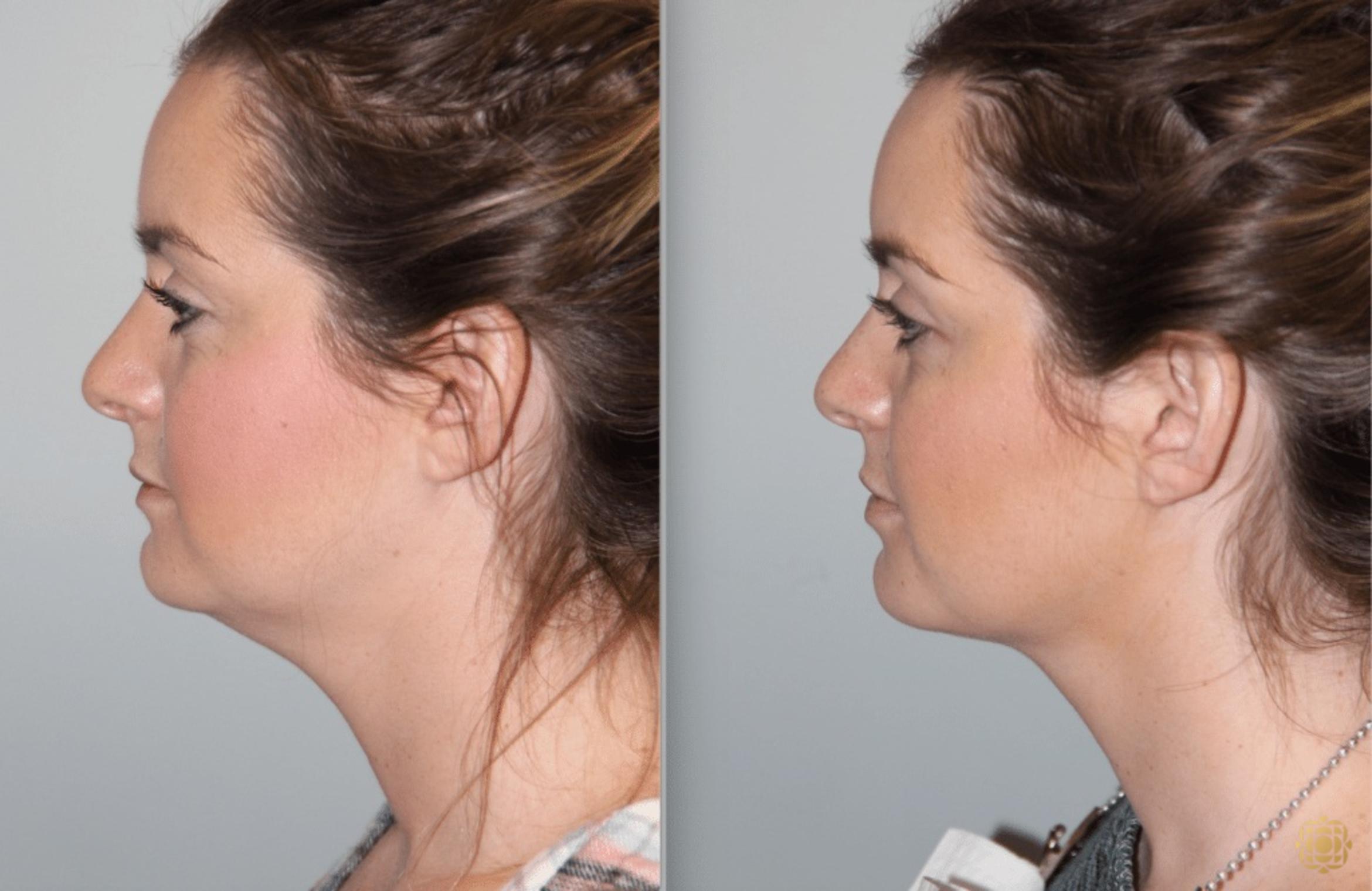 Before & After Injectables Case 382 View #1 View in Newport Beach, CA