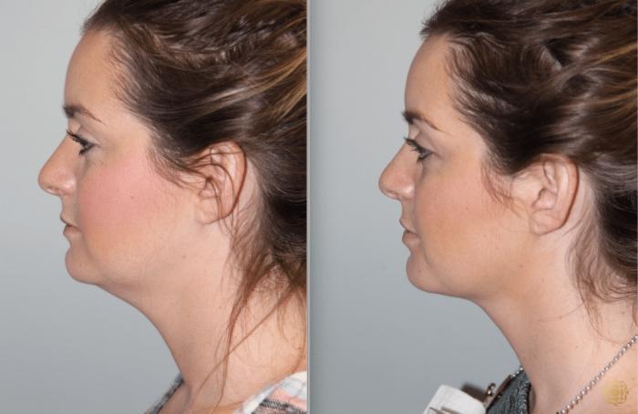 Before & After Injectables Case 382 View #1 View in Newport Beach, CA