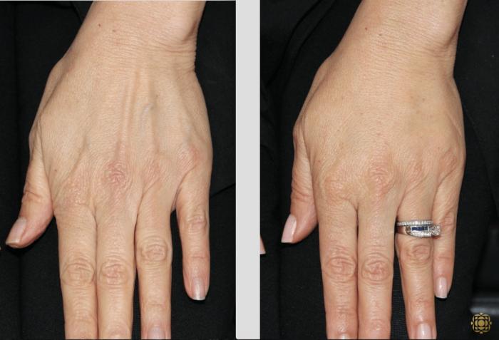 Before & After Injectables Case 383 View #1 View in Newport Beach, CA