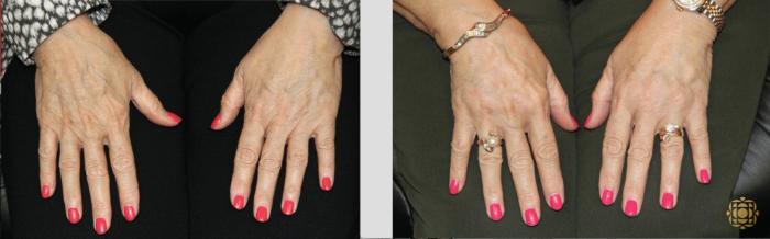 Before & After Injectables Case 384 View #1 View in Newport Beach, CA