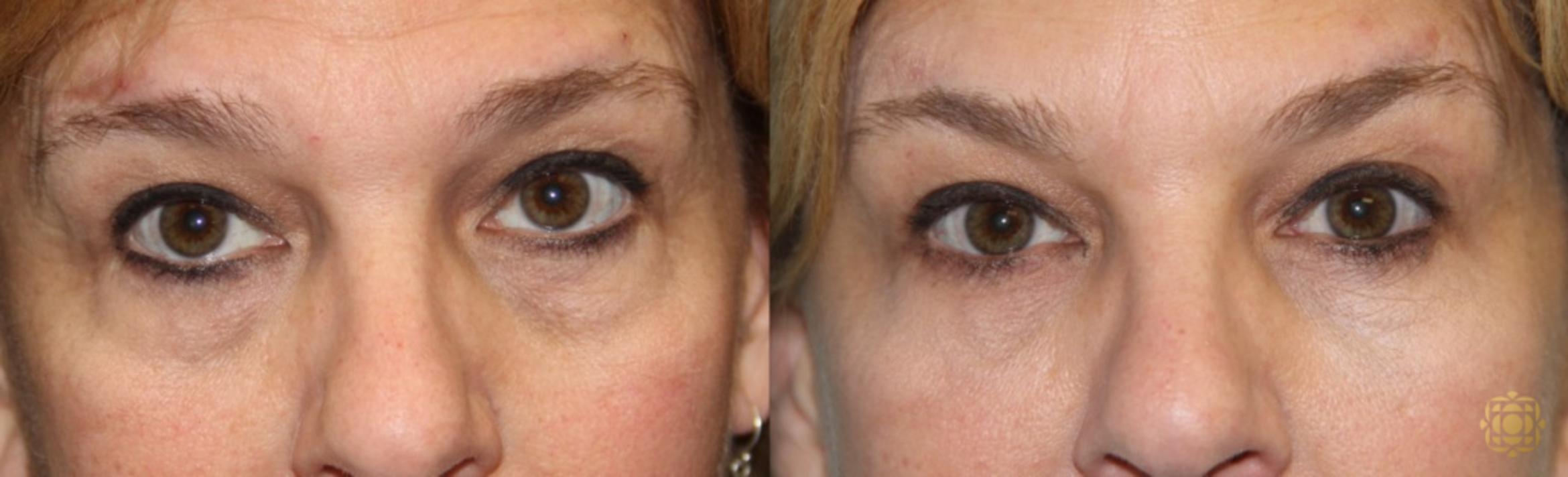 Before & After Injectables Case 385 View #1 View in Newport Beach, CA