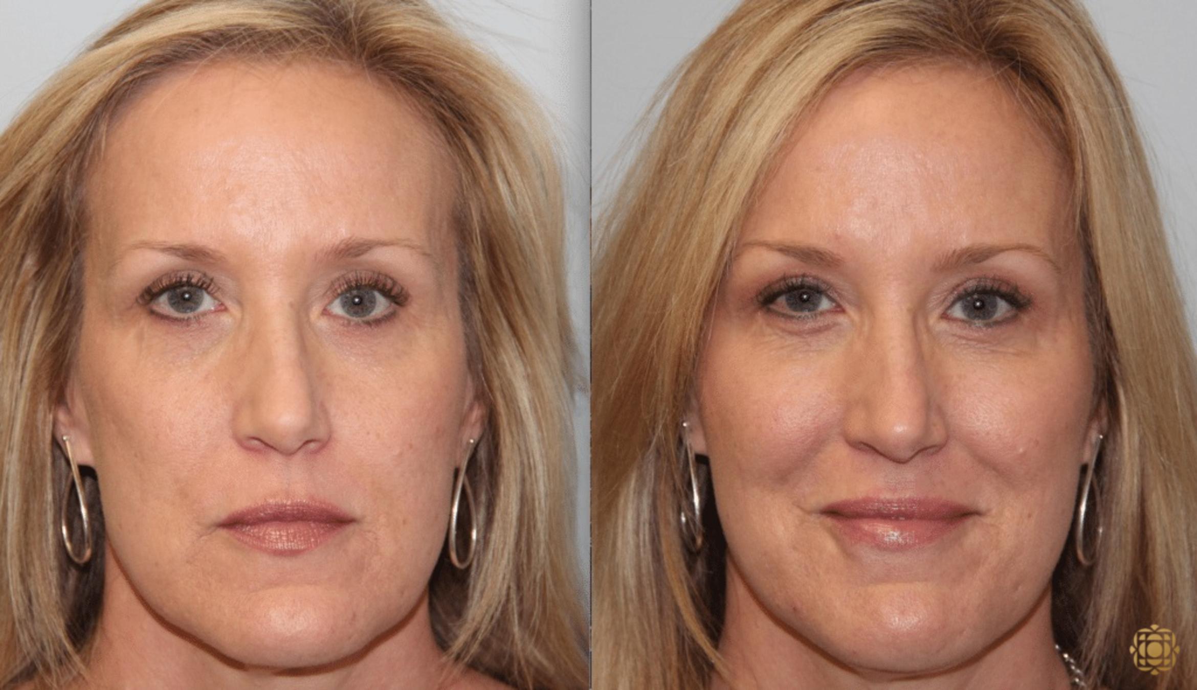 Before & After Injectables Case 386 View #1 View in Newport Beach, CA
