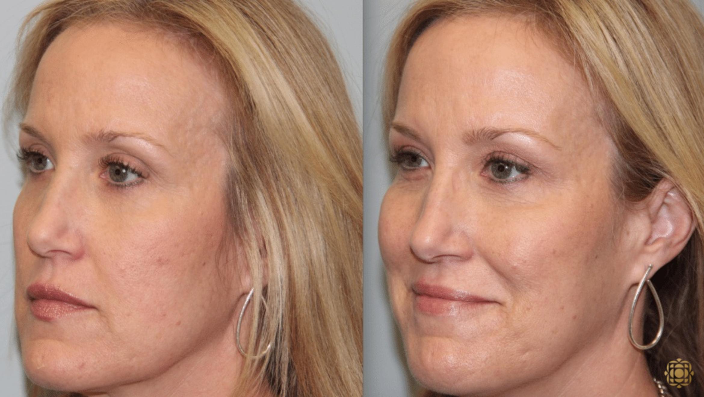 Before & After Injectables Case 386 View #2 View in Newport Beach, CA