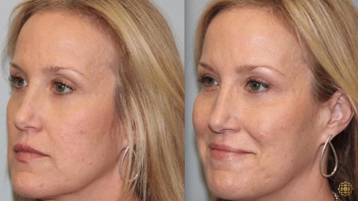 Before & After Injectables Case 386 View #2 View in Newport Beach, CA