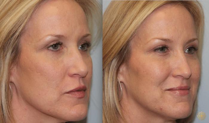 Before & After Injectables Case 386 View #3 View in Newport Beach, CA