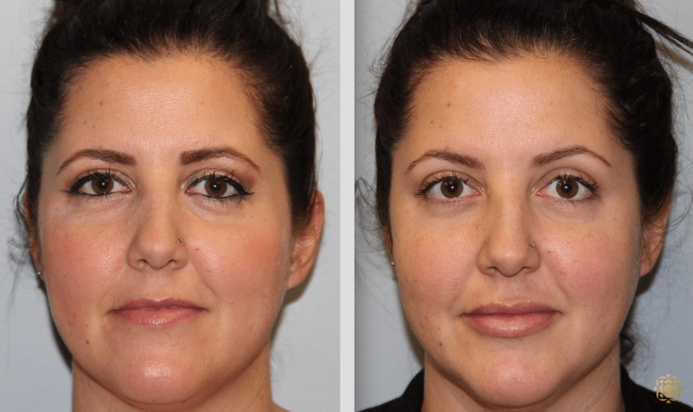 Before & After Injectables Case 388 View #1 View in Newport Beach, CA