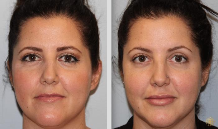 Before & After Injectables Case 388 View #1 View in Newport Beach, CA