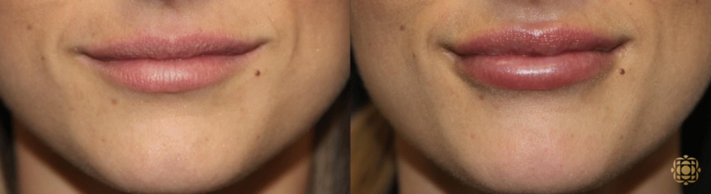 Before & After Injectables Case 389 View #1 View in Newport Beach, CA
