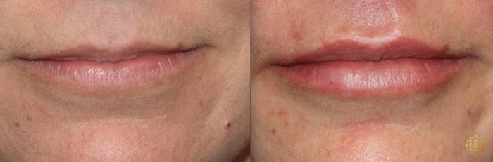 Before & After Injectables Case 391 View #1 View in Newport Beach, CA