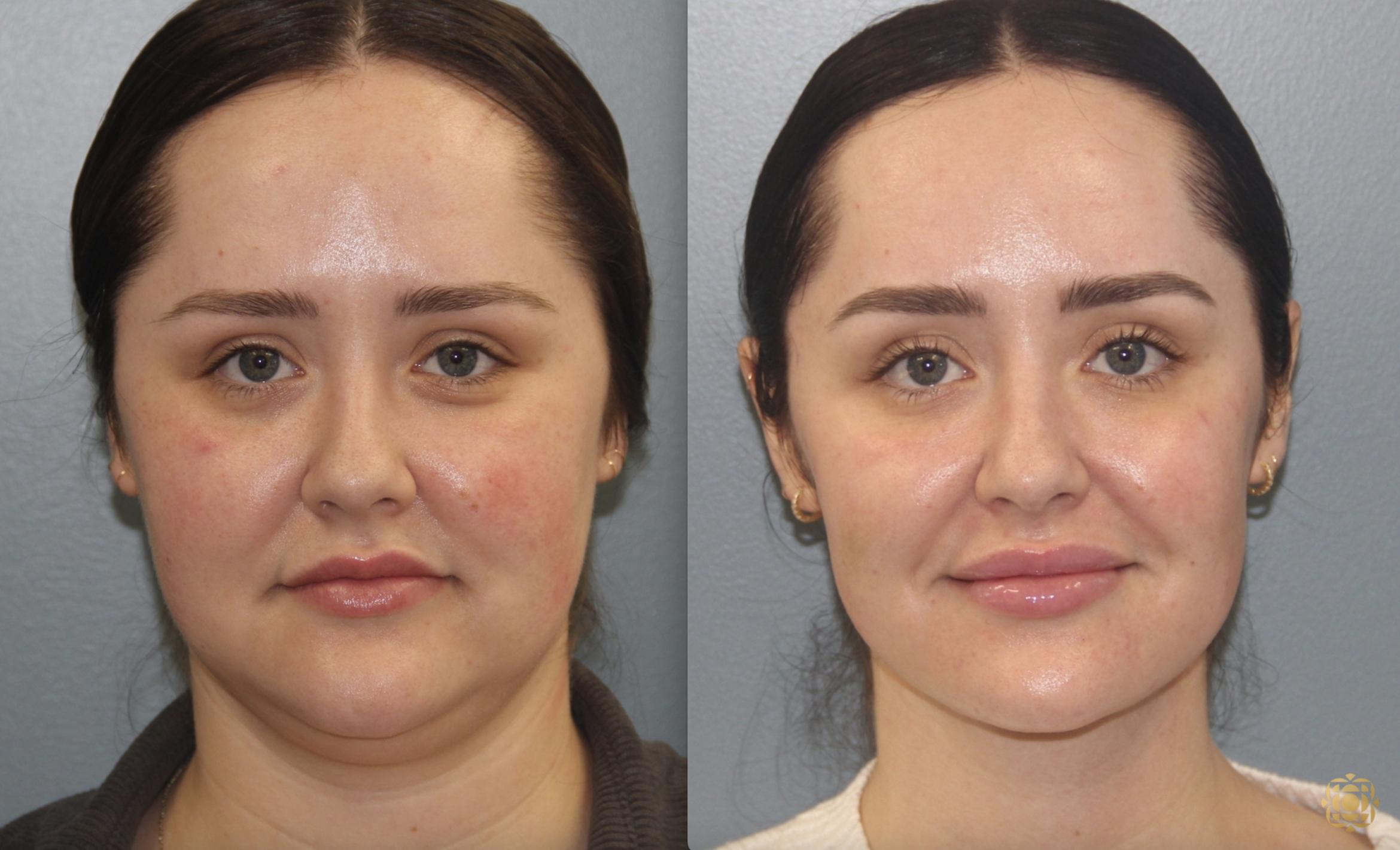 Before & After Neck Lift Case 407 Front View in Newport Beach, CA