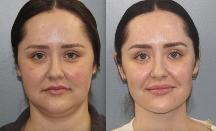 Before & After Neck Lift Case 407 Front View in Newport Beach, CA